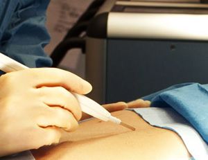 iKnife: un bisturí inteligente que detecta tejidos cancerígenos