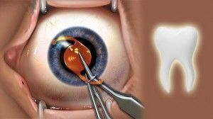 El extraño procedimiento para recuperar la vista con un diente