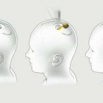 Neuralink: primer dispositivo funcional para leer el cerebro humano